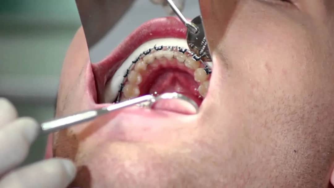 Jak włożyć drut do aparatu? Bezpieczna instrukcja krok po kroku